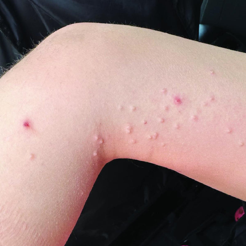 The Inflammation